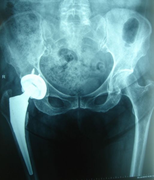 II. Anteroposterior x-ray pelvis shows the total hip arthroplasty three months down the line from the operation --------