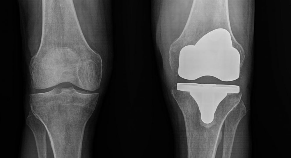 II. One month down the line from the operation, lateral x-ray of the knee -----