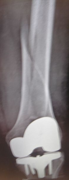 I. Anteroposterior x-ray of the femur shows the periprosthetic fracture --