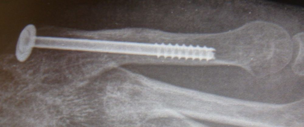 II. Four months post-surgery with union of the fracture and patient is walking without pain. -----