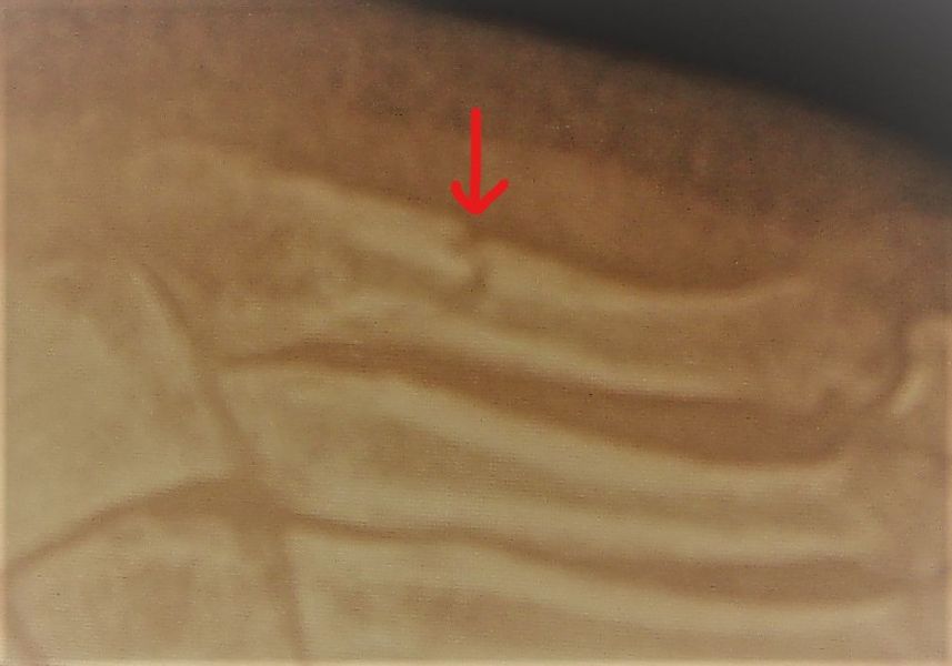 I. Before surgery, anteroposterior x-ray of the foot Inked--LI