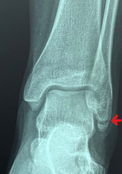 I. Before surgery, anteroposterior view of the ankle Inked--LI