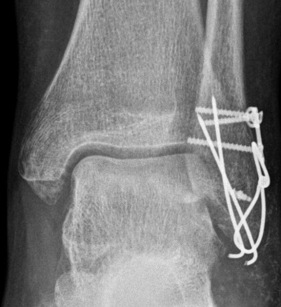 II. Four months post-surgery, anteroposterior view of the ankle shows the metal work and the union of fracture -----