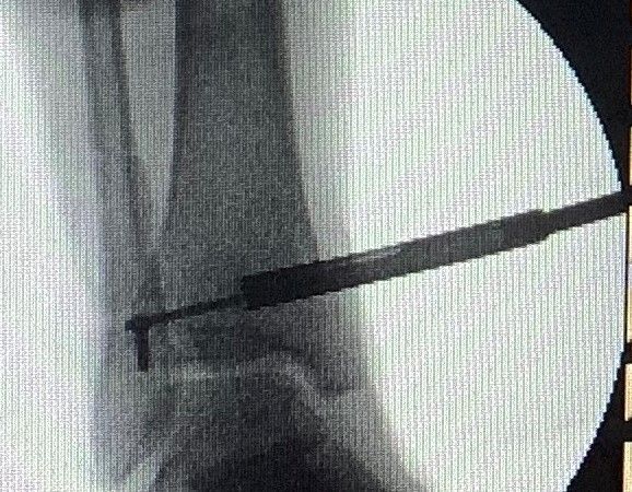 II. During the procedure a specific technique is using to remove the major part of the broken screw ----