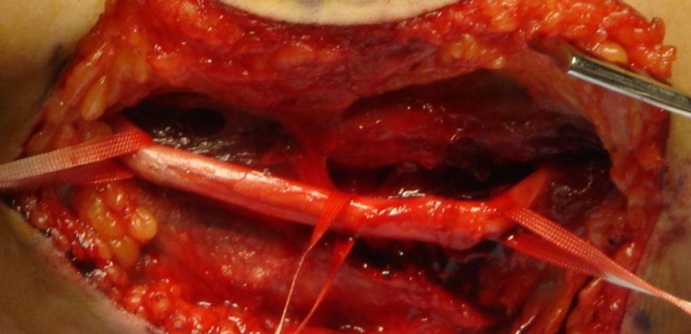 I. The image shows how it looks like the ulnar nerve after the decompression --