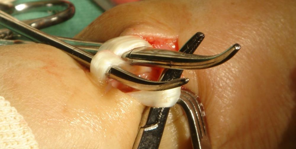 I. The image shows the release of tendons -----