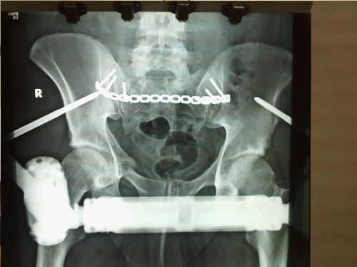 3-evdomades-metegxeiritika-anasynthesi-pyelou