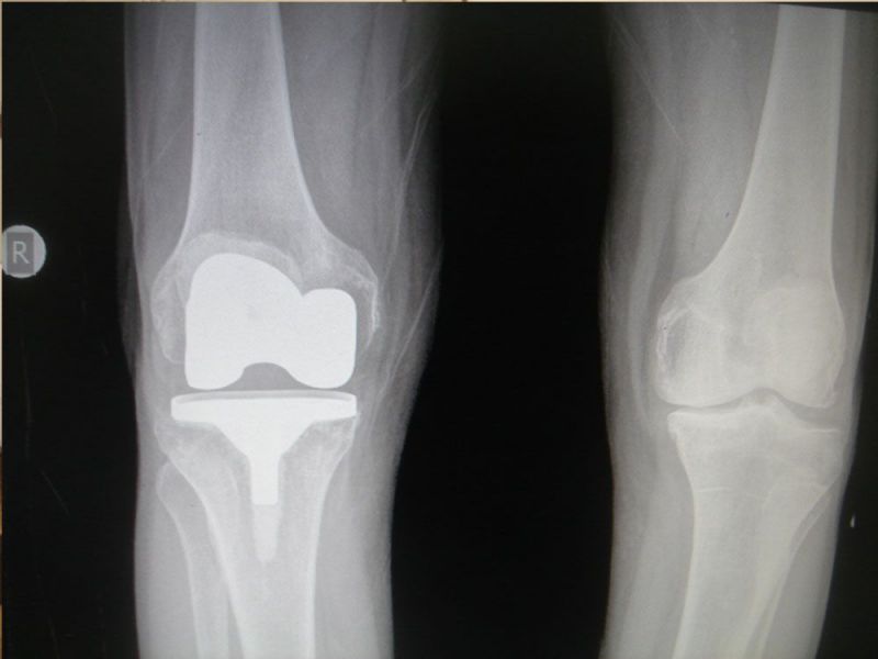 Οστεοαρθριτιδα-ολική αρθροπλαστική γόνατος σε άντρα 80 ετών osteoarthritida-osteoplastiki-gonatos