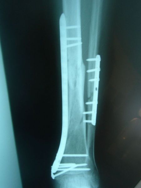 Πώρωση κατάγματος (8 μήνες μετεγχειρητικά) porwsi-katagmatos