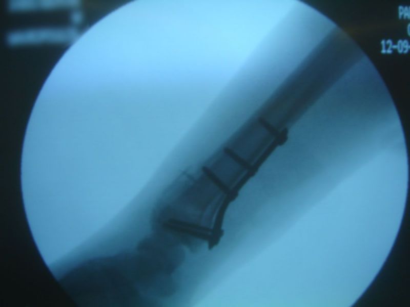 Ανοικτή ανάταξη εσωτερική οστεοσύνθεση κατω περατος κερκιδας (πλάγια προβολή διεγχειρητικά) - Distal radius fracture-open reduction internal fixation (lateral view) anoikti-anataxi-osteosynthesi