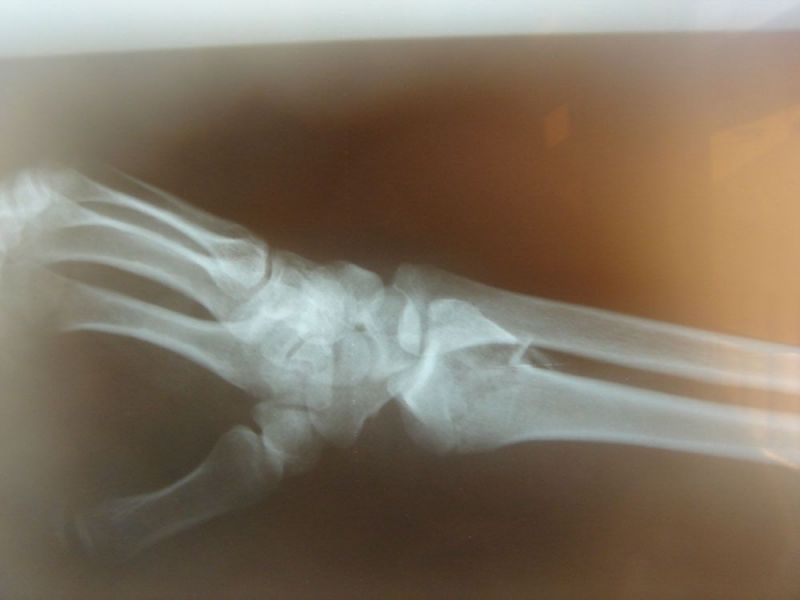 Κάταγμα κάτω πέρατος κερκίδας- Distal radius fracture-open reduction internal fixation (lateral view) katagma-katw-peratos-kerkidas-1