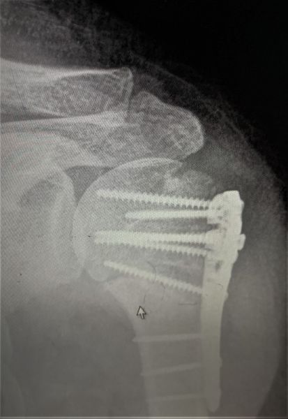 II. Two months post-surgery ----