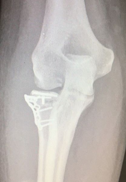 II. One-month post-surgery -----