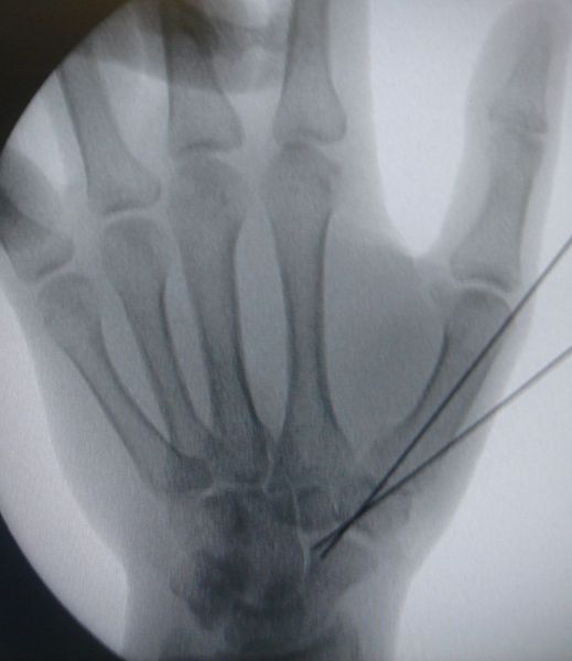 II. Day of surgery --