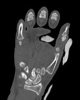 I. Before surgery, CT scan of the hand --