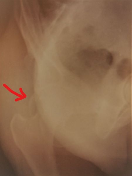 II. Obturator x-ray right acetabulum shows the reduction of the hip, the red arrow shows the fracture II---------