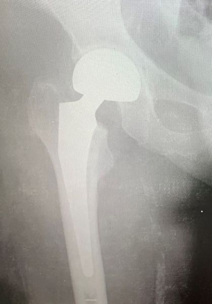 II. Post-surgery ---