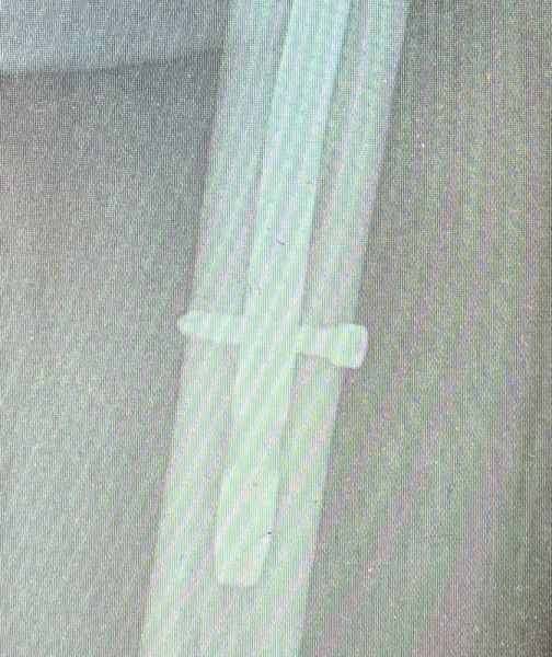 III. Post-surgery, x ray showing the distal part of the nail -------