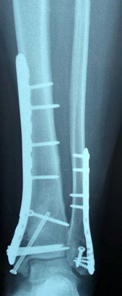 III. 2nd step, removal the external fixator and at the same time ORIF -2--------ORIF