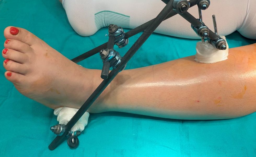 II. 1st step, the external fixator II-1o---